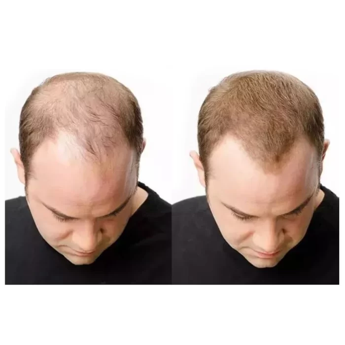 RejuveGrowth_rechargeable_hair_therapy_cap_6 rejuvegrowth_rechargeable_hair_therapy_cap_6